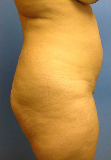 Vaser/Laser Liposculpture