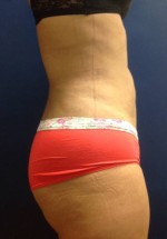 Vaser/Laser Liposculpture