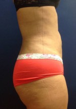 Vaser/Laser Liposculpture