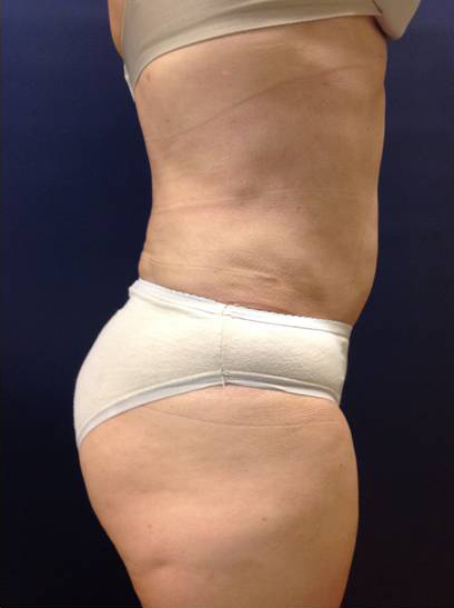 Vaser/Laser Liposculpture