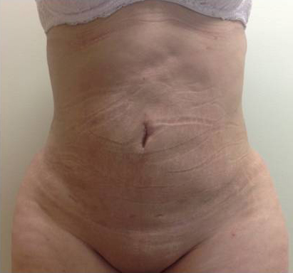 Vaser/Laser Liposculpture