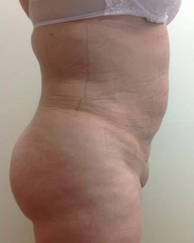 Vaser/Laser Liposculpture