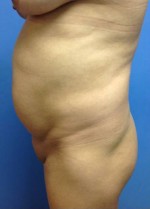 Vaser/Laser Liposculpture