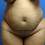 Abdominoplasty (Tummy Tuck)