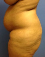 Abdominoplasty (Tummy Tuck)