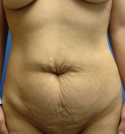 Abdominoplasty (Tummy Tuck)