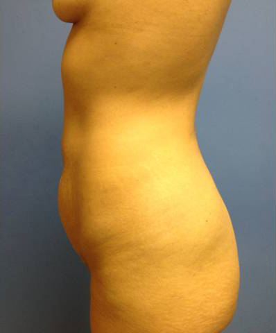 Abdominoplasty (Tummy Tuck)