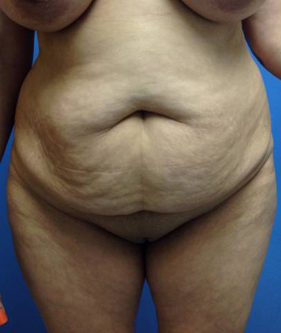 Abdominoplasty (Tummy Tuck)