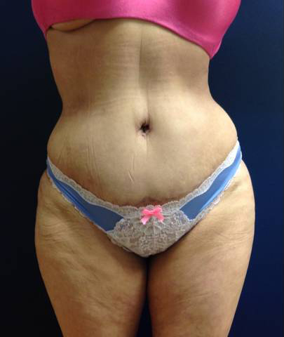 Abdominoplasty (Tummy Tuck)