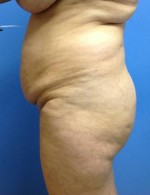 Abdominoplasty (Tummy Tuck)