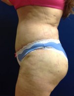 Abdominoplasty (Tummy Tuck)