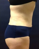 Abdominoplasty (Tummy Tuck)