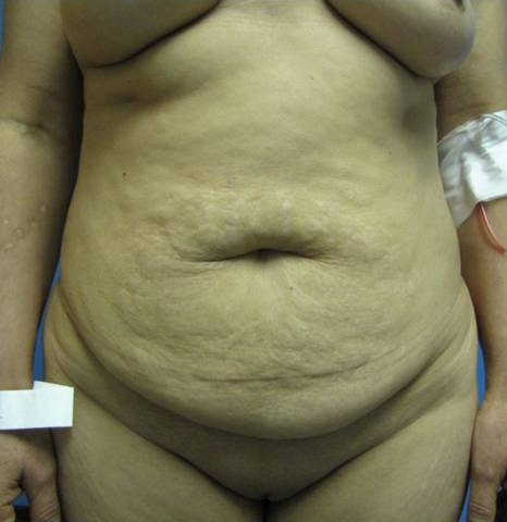 Abdominoplasty (Tummy Tuck)