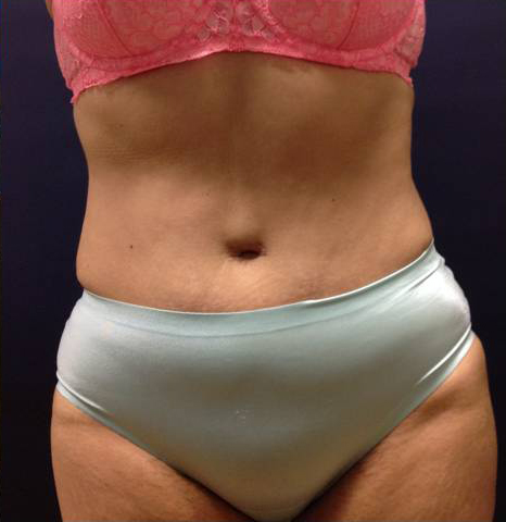 Abdominoplasty (Tummy Tuck)