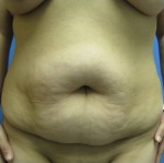 Abdominoplasty (Tummy Tuck)