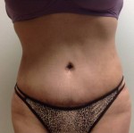 Abdominoplasty (Tummy Tuck)