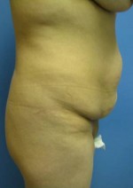 Abdominoplasty (Tummy Tuck)