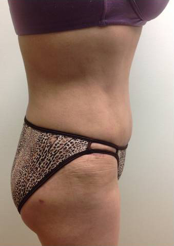 Abdominoplasty (Tummy Tuck)