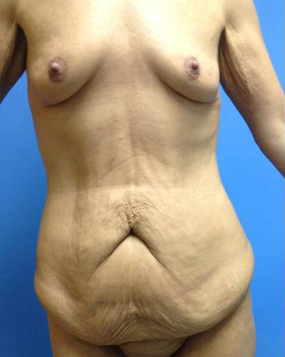 Abdominoplasty (Tummy Tuck)