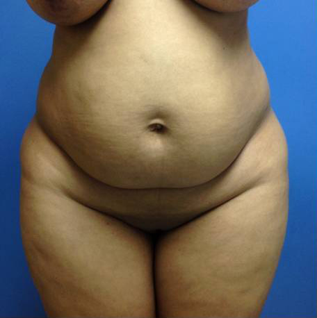 Abdominoplasty (Tummy Tuck)