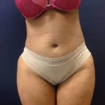 Abdominoplasty (Tummy Tuck)