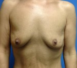 Breast Augmentation