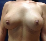 Breast Augmentation