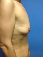 Breast Augmentation