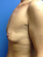 Breast Augmentation