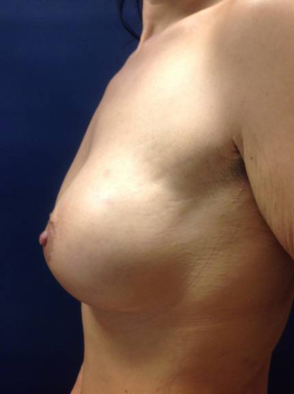 Breast Augmentation