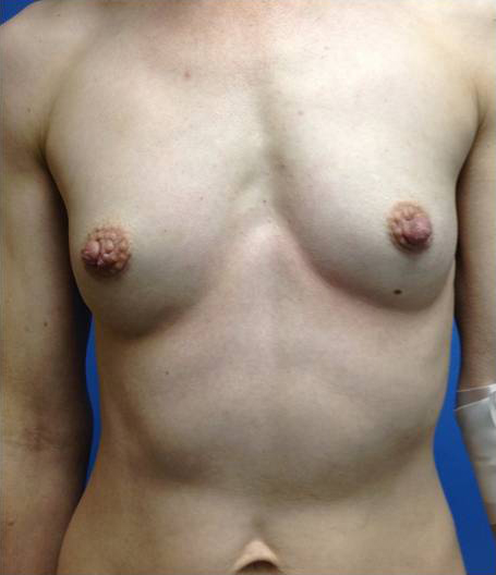 Breast Augmentation