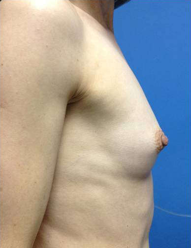 Breast Augmentation