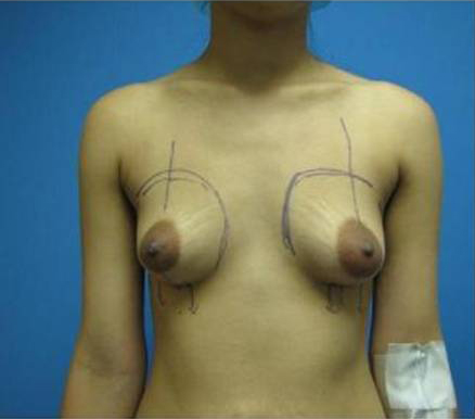 Breast Augmentation