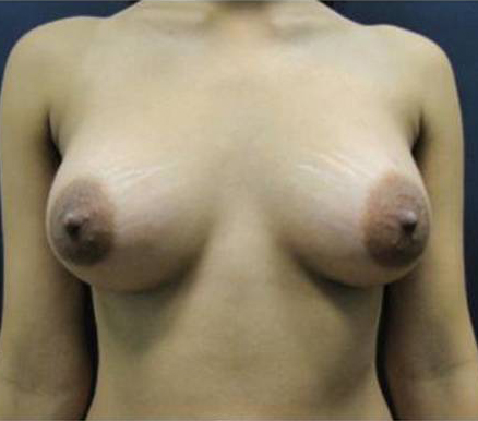 Breast Augmentation