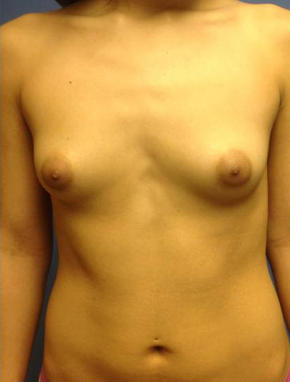 Breast Augmentation