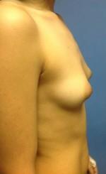 Breast Augmentation