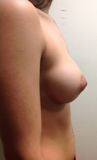 Breast Augmentation