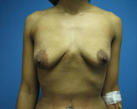 Breast Augmentation