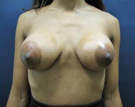 Breast Augmentation