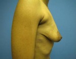 Breast Augmentation