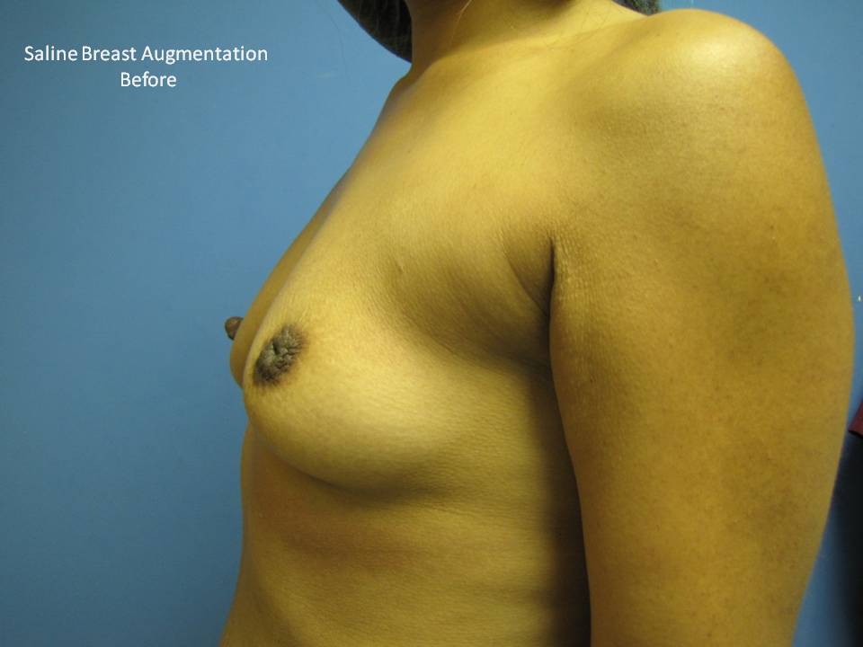 Breast Augmentation