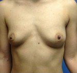 Breast Augmentation