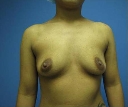 Breast Augmentation