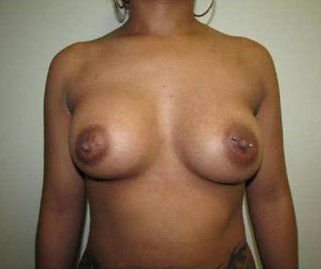 Breast Augmentation