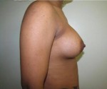 Breast Augmentation