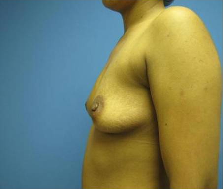 Breast Augmentation