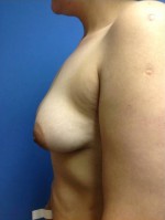 Breast Augmentation