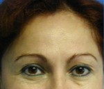 Eyelid Surgery