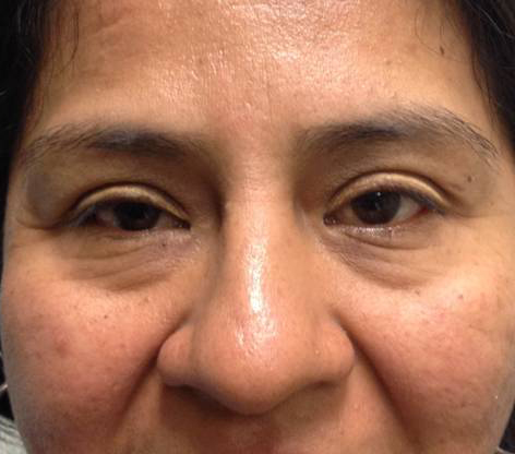 Eyelid Surgery