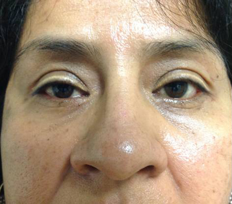 Eyelid Surgery